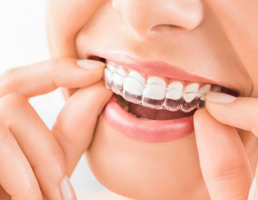 Angel Aligners